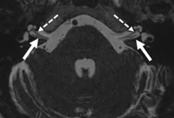 Cranial nerve VII and VIII