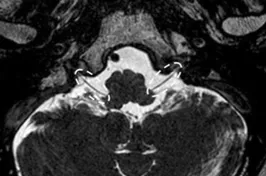 Cranial nerve IX and X