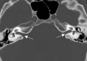 Internal auditory meatus