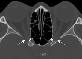 Optic canal and superior orbital fissure